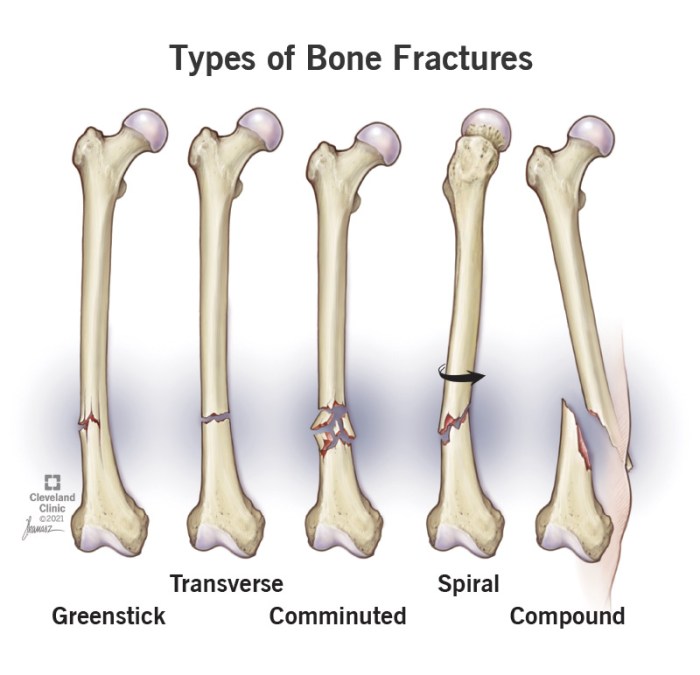 What is a compound fracture quizlet