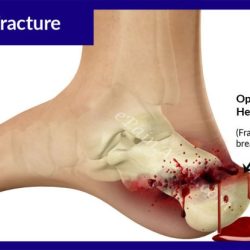 Fracture open broken ray fractures illustration compound bone tibia skin treatment through after called bones soft break orthoinfo show aaos