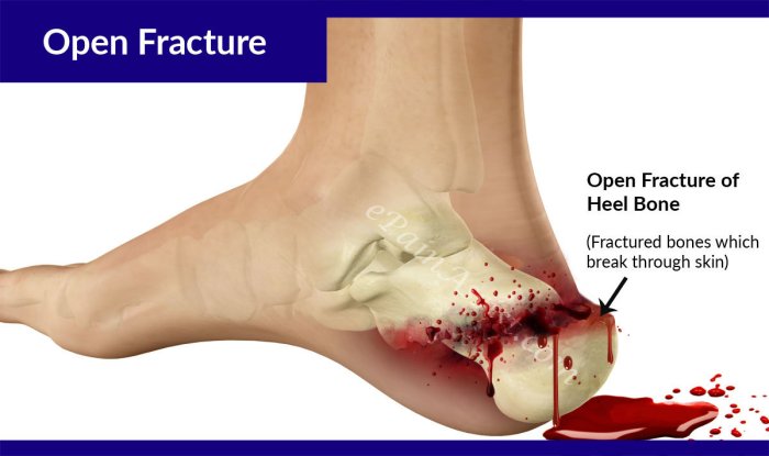 Fracture open broken ray fractures illustration compound bone tibia skin treatment through after called bones soft break orthoinfo show aaos