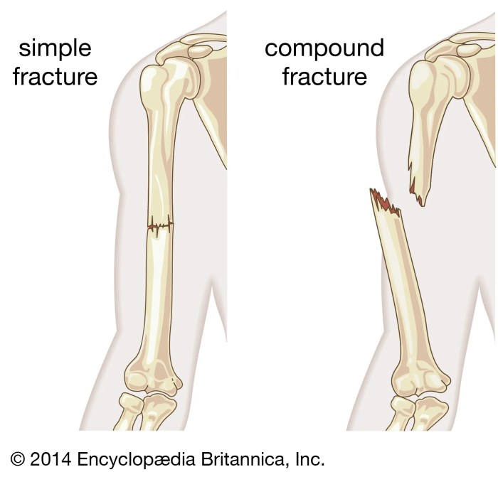 What is a compound fracture quizlet