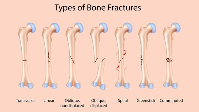 Tibia fibula nailing fracture tibial shaft intramedullary rays nail fractures aaos orthoinfo shinbone